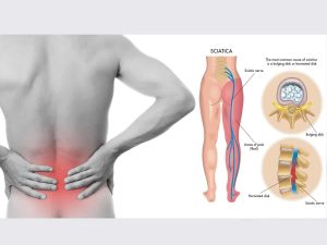 My Back Pain Coach Review - How I Cure My Sciatica Without Surgery